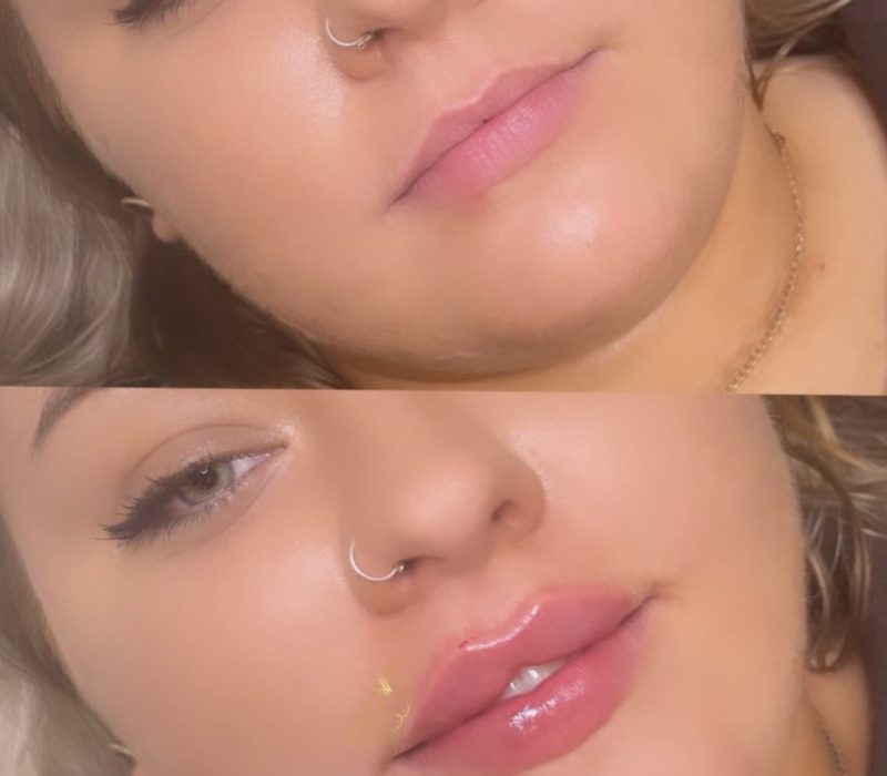 Russian lip fillers in Sydney